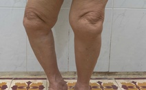 Lấy lại dáng đi cho người phụ nữ 69 tuổi nhờ kỹ thuật thay khớp gối bản lề