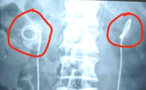 Quên rút ống thông niệu quản suốt 2 năm, người đàn ông biến chứng nặng nề