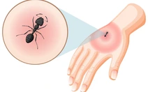 Thực hư chuyện dùng kiến để xua đuổi muỗi truyền bệnh chikungunya