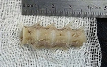 Hóc đoạn xương sống cá 4cm trong cổ, cụ ông 99 tuổi nguy kịch