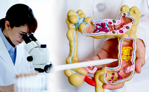 Phương pháp mới phát hiện 90% ca ung thư đại trực tràng không cần nội soi