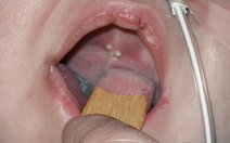 Con bạn có nanh sữa khi vừa sinh, có cần điều trị sớm?