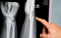 Vi nhựa xâm nhập tủy xương người, gây hại ra sao?