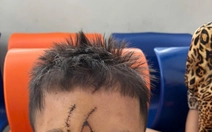 Huy động 3 chuyên khoa, cứu khuôn mặt bé trai 5 tuổi bị chó béc giê cắn xé