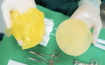 Bác sĩ nói gì về nguy cơ vỡ túi ngực khi chơi pickleball?