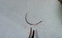 Lấy dị vật kim khâu nằm trong tầng sinh môn nữ bệnh nhân sau 11 năm