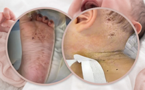 Bé 10 tháng tuổi suýt mất mạng vì bị mẹ châm kim hàng trăm lần để 'chữa bệnh'