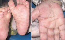 Bé trai gần 3 tuổi mắc giang mai dù không có triệu chứng