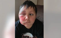 Bé trai bỏng nặng vì làm theo trào lưu TikTok cho đồ chơi vào lò vi sóng