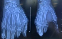 8 tiếng phẫu thuật nối 4 ngón tay đứt lìa