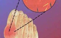 Thuốc điều trị gout