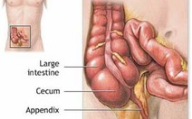 Viêm ruột thừa có khi khó... đoán