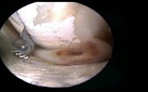 Vừa đau khớp vừa nhiễm trùng tiểu