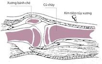 Truyền nước biển vào... tủy xương