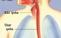 Polyp thực quản lành tính