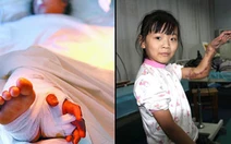 Bàn tay được ghép vào chân