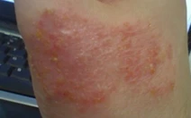 Hội thảo tư vấn về viêm da, chàm, da dị ứng