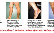 Thảo dược suy giãn tĩnh mạch chân hiệu quả