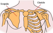 Xương đòn gãy, để tự lành tốt hơn phẫu thuật