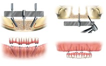 Lớn tuổi vẫn cấy ghép răng được