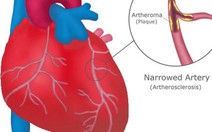 Blog bác sĩ: Bạn có bệnh tim không?
