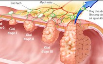 Sáu bí quyết giảm nguy cơ ung thư đại tràng