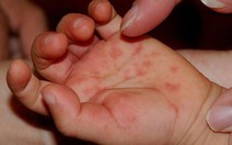 ​Chăm sóc trẻ bệnh tay chân miệng