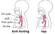 Nhiều năm thức ăn không xuống  dạ dày