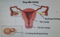 Bắt đền vì chẩn đoán viêm ruột thừa nhưng mổ thấy nang buồng trứng