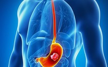 ​Nhật Bản công bố phương pháp mới điều trị ung thư thực quản