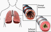 Lấy hạt dưa nằm trong  đường thở hai tuần