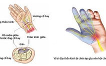 ​Hội chứng ống cổ tay – căn bệnh nhân viên văn phòng thường gặp