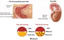 ​Biến chứng thận do tăng huyết áp