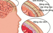 ​Cảnh báo những nguy hiểm của bệnh viêm não