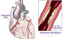 ​Bệnh động mạch vành và những điều cần biết