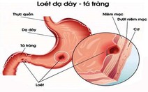 ​Nguyên nhân gây viêm loét dạ dày - tá tràng