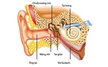 Coi chừng điếc vì viêm tai giữa