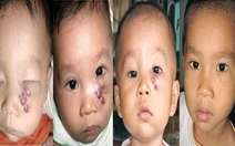 U máu, lành nhưng mệt