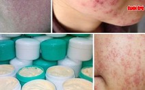 Rước họa vì làm đẹp bằng “kem trộn” chứa Coticoid