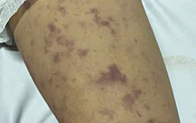 Xã Thường Tân, TP.HCM thông báo ghi nhận ca mắc não mô cầu ở trẻ 12 tuổi