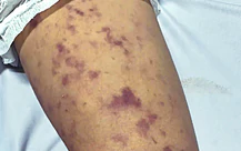 Xã Thường Tân, TP.HCM thông báo ghi nhận ca mắc não mô cầu ở trẻ 12 tuổi
