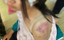 Bé gái bị bà nội, ông dượng và anh trai bà nội đánh đập dã man