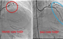 Bệnh viện Tâm Trí Cao Lãnh cứu sống cụ bà bị nhồi máu cơ tim cấp