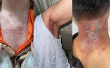 Kiến ba khoang 'vào mùa', cẩn trọng nhầm tổn thương da với zona thần kinh