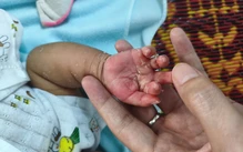 Trẻ 2 tháng tuổi mắc giang mai bẩm sinh, dễ nhầm bệnh ngoài da