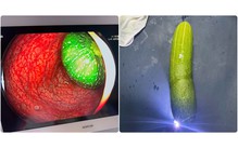 Nam sinh lớp 9 nhập viện vì 'nghịch dại', đưa quả dưa chuột dài 20cm vào hậu môn
