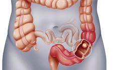 90% ung thư đại trực tràng được chữa khỏi, nếu được phát hiện sớm