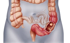 Ai thuộc nhóm dễ bị polyp đại tràng?