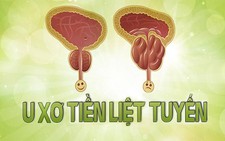 Mổ u xơ tuyến tiền liệt có ảnh hưởng đến chuyện chăn gối?