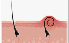 Lông mọc ngược, bài học cảnh giác ung thư hắc tố